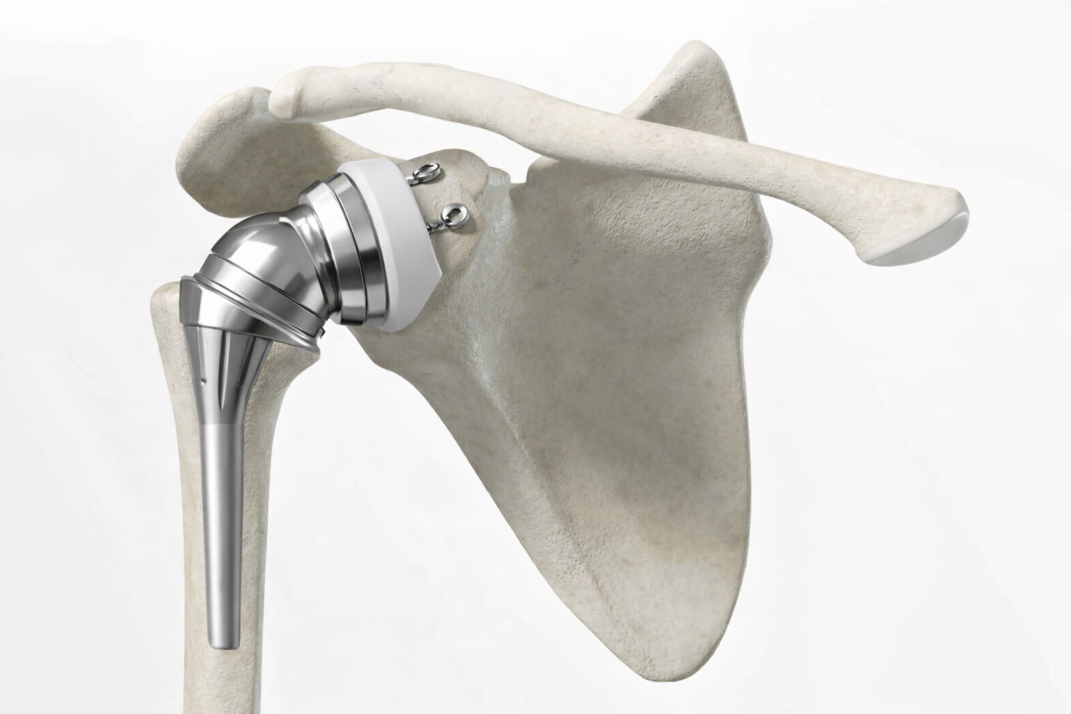 Prothèse épaule tunisie